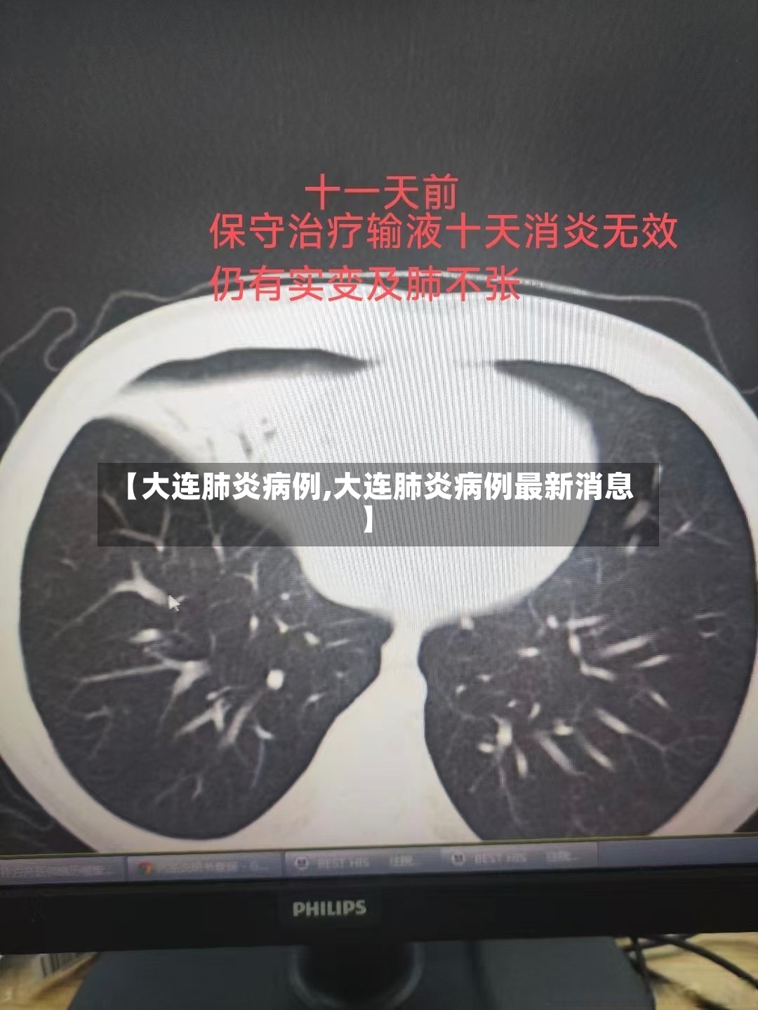 【大连肺炎病例,大连肺炎病例最新消息】